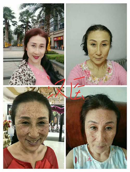 純中藥祛斑代理加盟招商